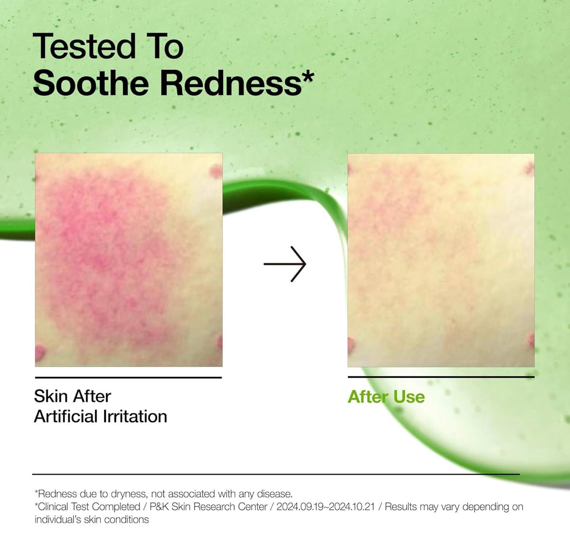Anua Azelaic Acid 10% & Hyaluron Redness Soothing Serum 30ML – Calming & Hydrating Serum for Sensitive Skin - Korean Beauty KR